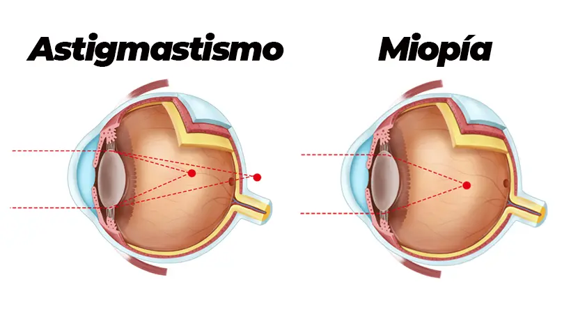 astigmatismo y miopia diferencias sintomas causas soluciones tratamientos